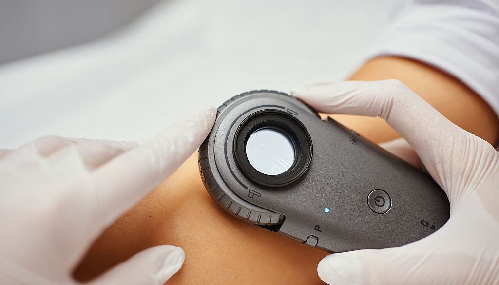 Jak obserwować znamiona między wizytami i kiedy zgłosić się na dermatoskopię